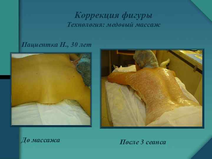 Коррекция фигуры Технология: медовый массаж Пациентка Н. , 30 лет До массажа После 3