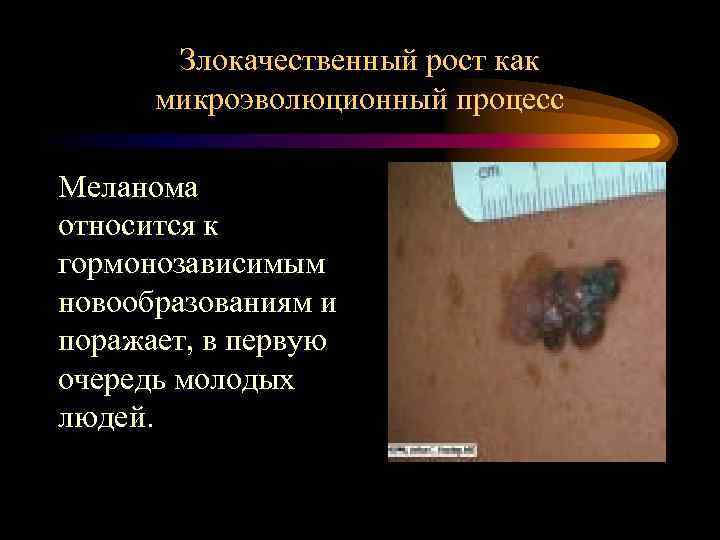 Злокачественный рост как микроэволюционный процесс Меланома относится к гормонозависимым новообразованиям и поражает, в первую