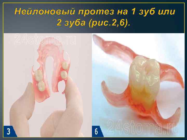  Нейлоновый протез на 1 зуб или 2 зуба (рис. 2, 6). 