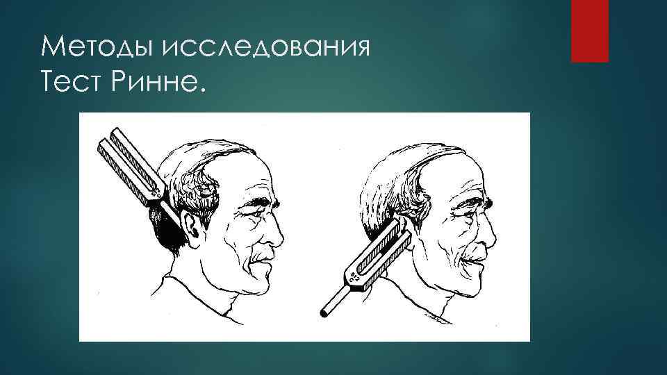 Методы исследования Тест Ринне. 