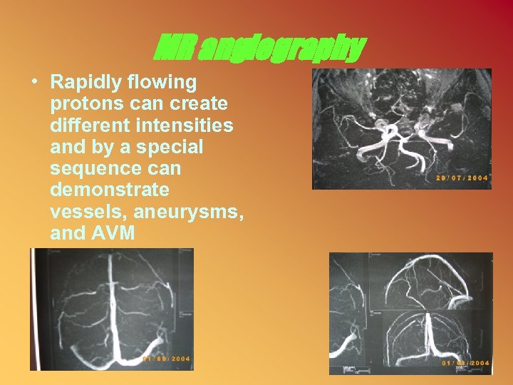 MR angiography • Rapidly flowing protons can create different intensities and by a special