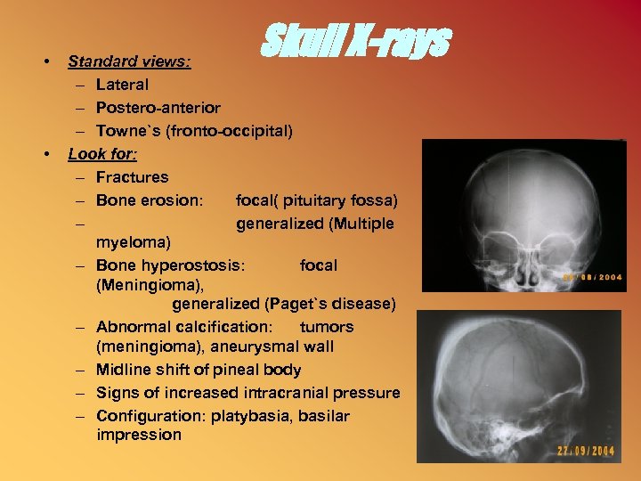  • • Skull X-rays Standard views: – Lateral – Postero-anterior – Towne`s (fronto-occipital)