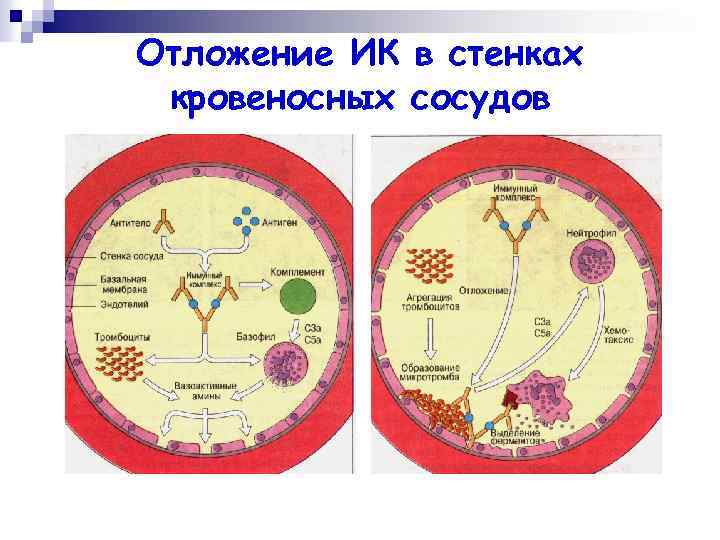 Отложение ИК в стенках кровеносных сосудов 