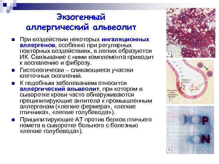 Экзогенный аллергический альвеолит n n При воздействии некоторых ингаляционных аллергенов, особенно при регулярных повторных