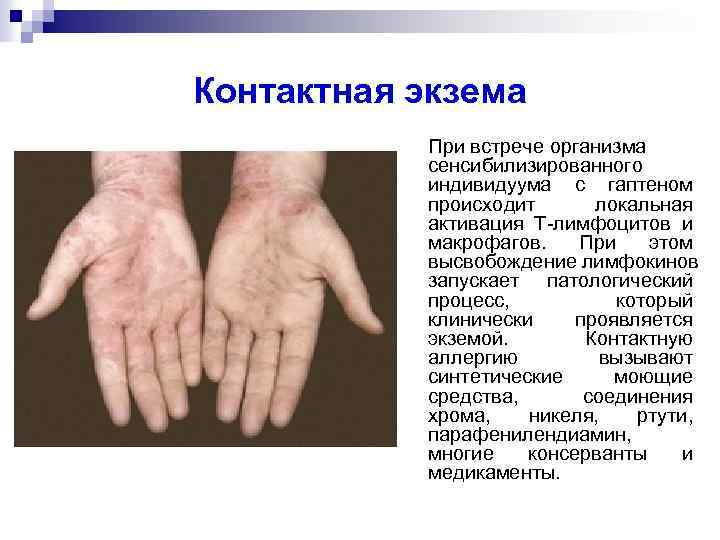 Контактная экзема При встрече организма сенсибилизированного индивидуума с гаптеном происходит локальная активация Т-лимфоцитов и