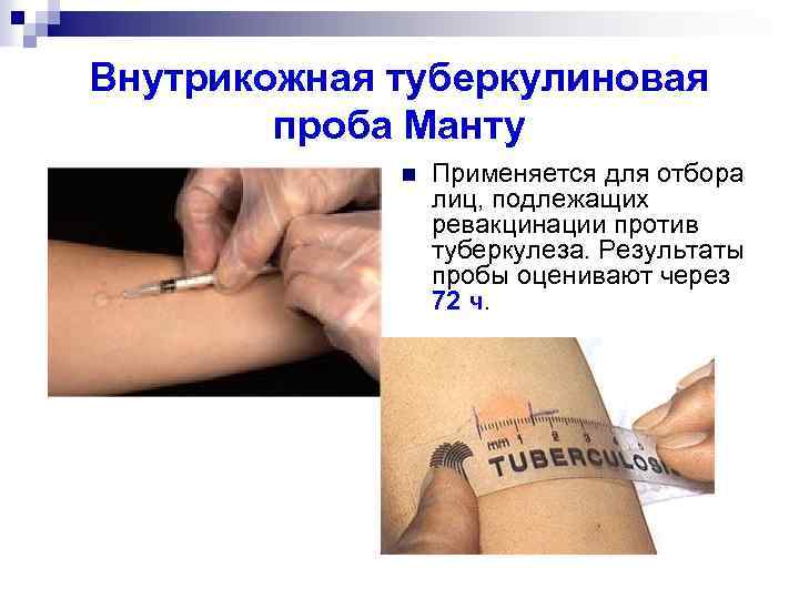 Внутрикожная туберкулиновая проба Манту n Применяется для отбора лиц, подлежащих ревакцинации против туберкулеза. Результаты
