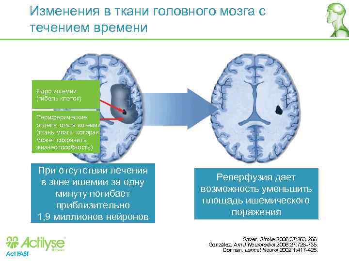 Изменения в ткани головного мозга с течением времени Ядро ишемии (гибель клеток) Периферические отделы