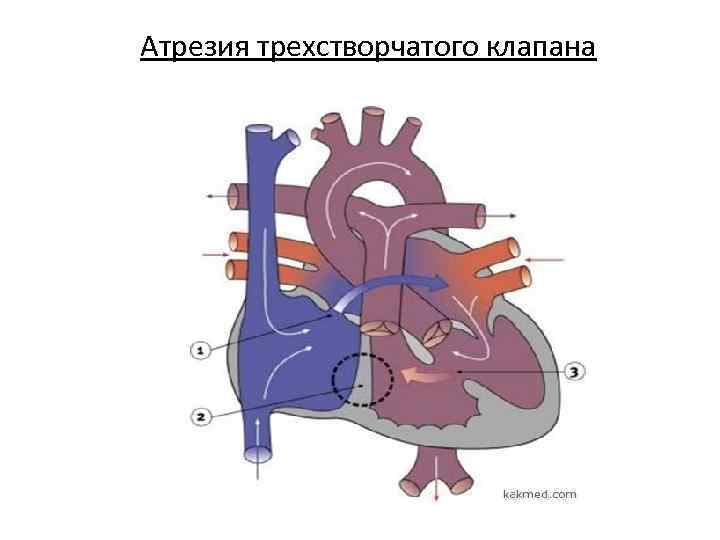 Атрезия трехстворчатого клапана презентация