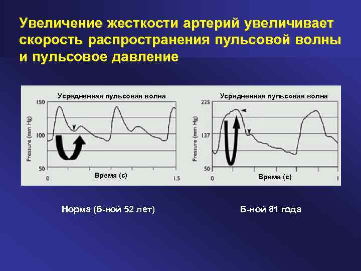 Пульсовое давление это. Скорость пульсовой волны норма. Пульсовая волна скорость ее распространения. Уравнение гармонической пульсовой волны. Форма пульсовой волны.