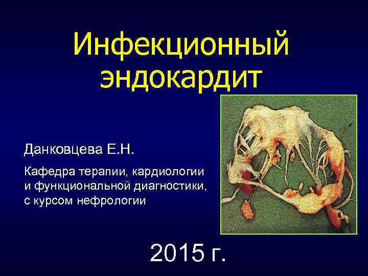 Инфекционный эндокардит Данковцева Е. Н. Кафедра терапии, кардиологии и функциональной диагностики, с курсом нефрологии