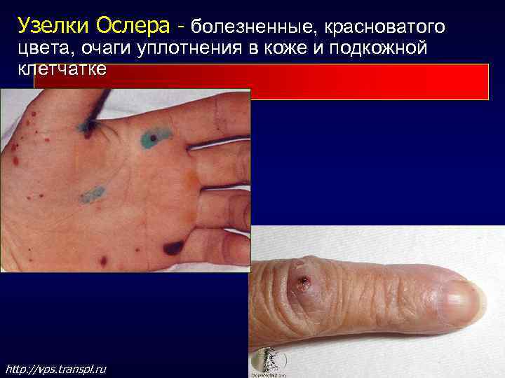 Узелки Ослера - болезненные, красноватого цвета, очаги уплотнения в коже и подкожной клетчатке http: