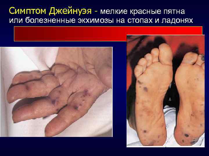 Симптом Джейнуэя - мелкие красные пятна или болезненные экхимозы на стопах и ладонях 