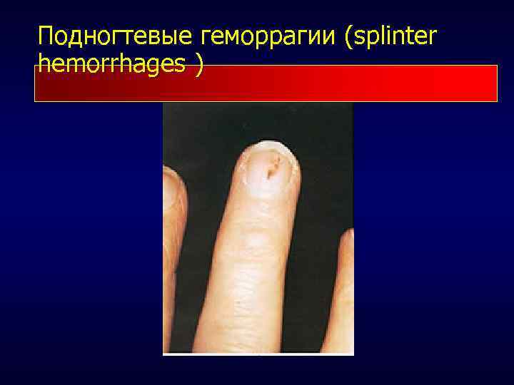Подногтевые геморрагии (splinter hemorrhages ) 