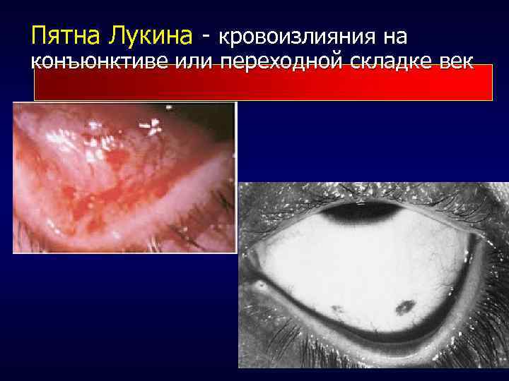 Пятна Лукина - кровоизлияния на конъюнктиве или переходной складке век 