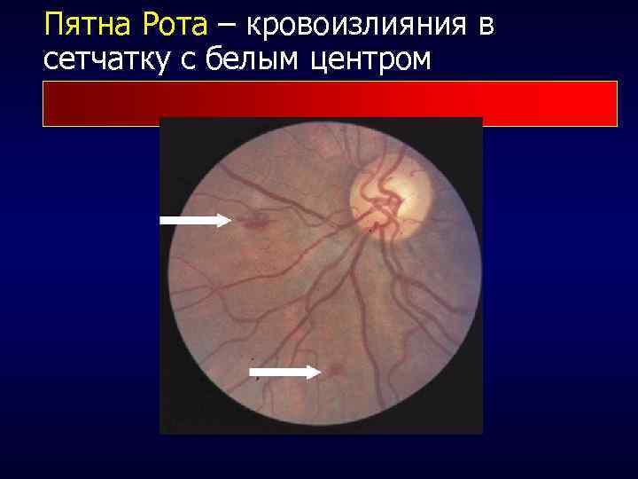 Пятна Рота – кровоизлияния в сетчатку с белым центром 
