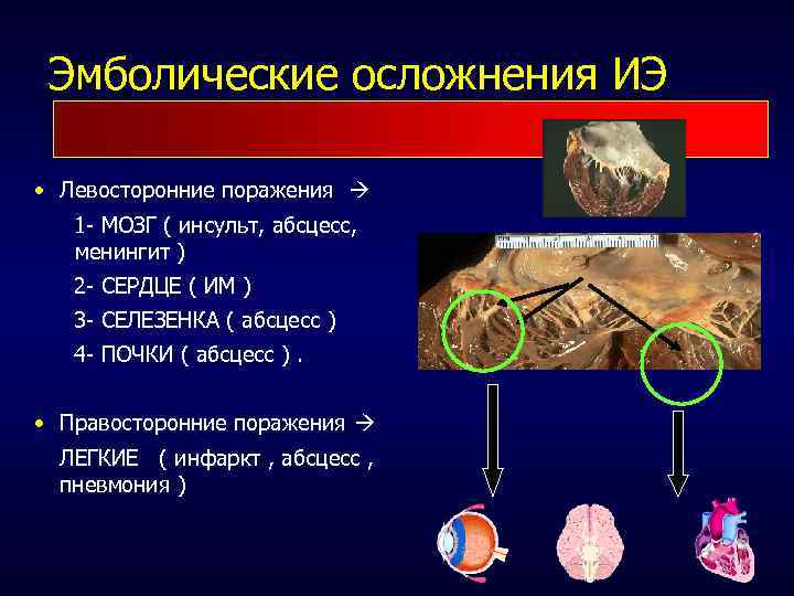 Эмболические осложнения ИЭ • Левосторонние поражения 1 - МОЗГ ( инсульт, абсцесс, менингит )