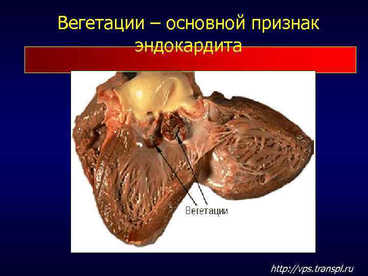 Вегетации – основной признак эндокардита http: //vps. transpl. ru 