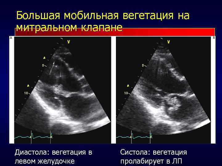 Большая мобильная вегетация на митральном клапане Диастола: вегетация в левом желудочке Систола: вегетация пролабирует