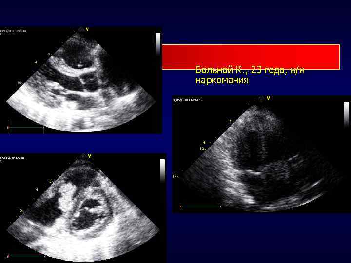 Больной К. , 23 года, в/в наркомания 