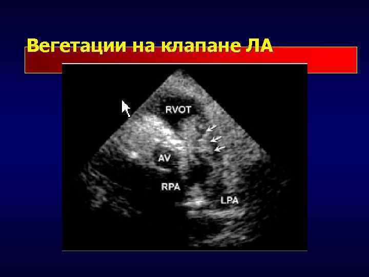Вегетации на клапане ЛА 