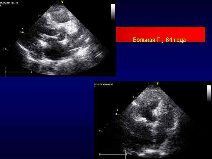 Больная Г. , 84 года 