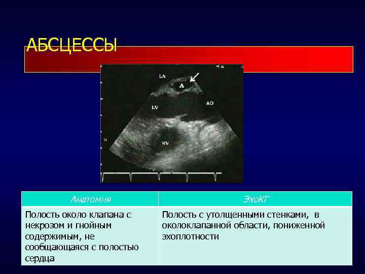 АБСЦЕССЫ Анатомия Полость около клапана с некрозом и гнойным содержимым, не сообщающаяся с полостью