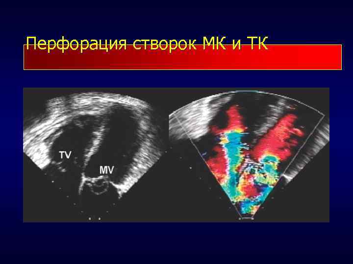 Перфорация створок МК и ТК 