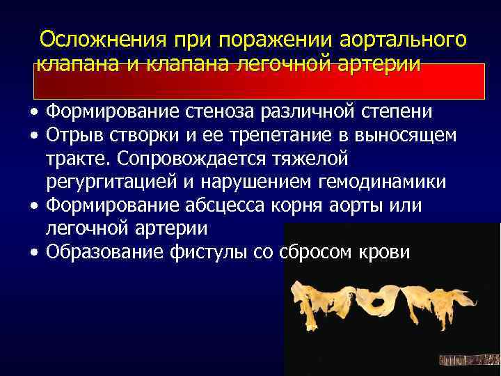  Осложнения при поражении аортального клапана и клапана легочной артерии • Формирование стеноза различной
