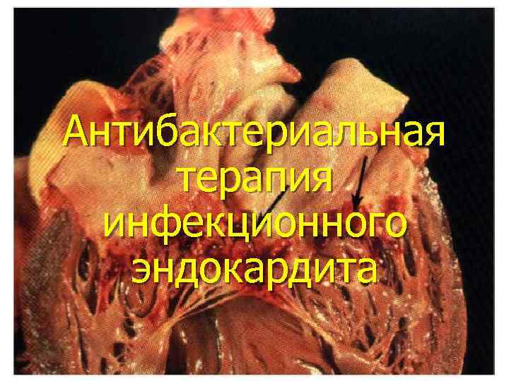 Антибактериальная терапия инфекционного эндокардита 