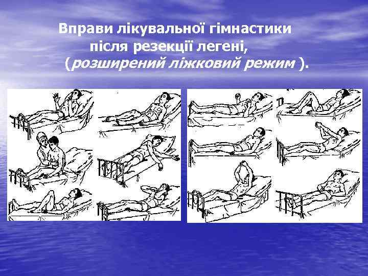 Вправи лікувальної гімнастики після резекції легені, (розширений ліжковий режим ). 