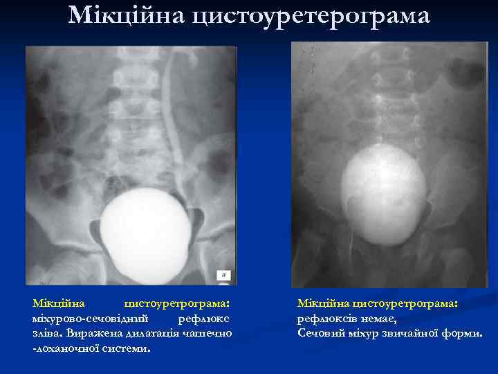 Мікційна цистоуретерограма Мікційна цистоуретрограма: міхурово-сечовідний рефлюкс зліва. Виражена дилатація чашечно -лоханочної системи. Мікційна цистоуретрограма: