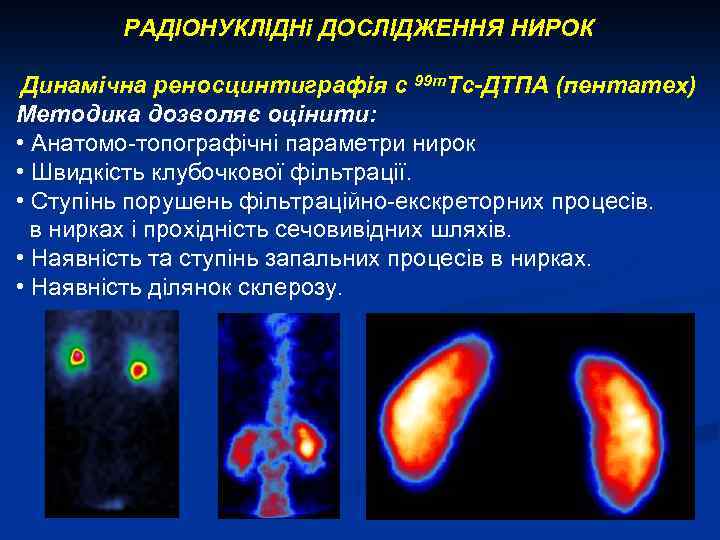 РАДІОНУКЛІДНі ДОСЛІДЖЕННЯ НИРОК Динамічна реносцинтиграфія с 99 m. Тс-ДТПА (пентатех) Методика дозволяє оцінити: •