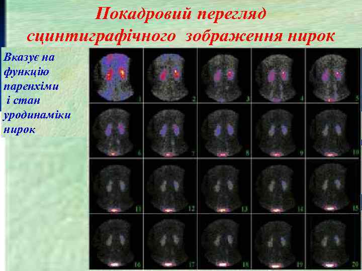 Покадровий перегляд сцинтиграфічного зображення нирок Вказує на функцію паренхіми і стан уродинаміки нирок 