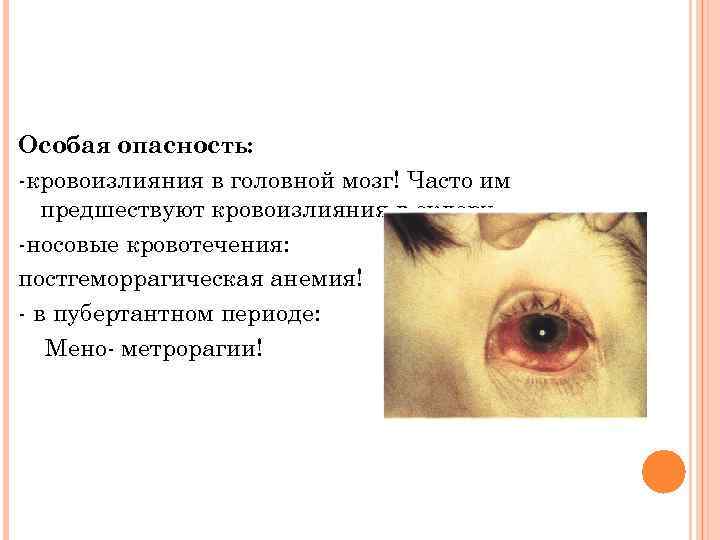 Особая опасность: -кровоизлияния в головной мозг! Часто им предшествуют кровоизлияния в склеру. -носовые кровотечения: