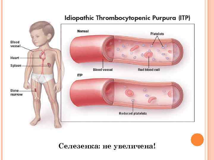 Тромбоцитопения у новорожденных. Геморрагические диатезы тромбоцитопеническая пурпура. Сыпь тромбоцитопенической пурпуры. Тромбоцитопеническая пурпура петехии. Изоиммунная тромбоцитопения пурпура.