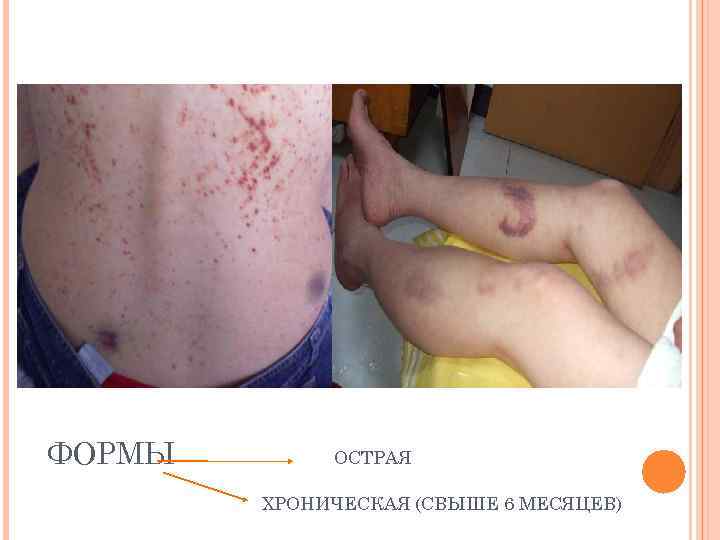 ФОРМЫ ОСТРАЯ ХРОНИЧЕСКАЯ (СВЫШЕ 6 МЕСЯЦЕВ) 