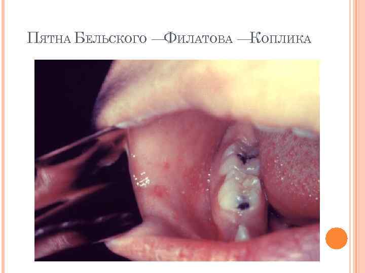 ПЯТНА БЕЛЬСКОГО —ФИЛАТОВА —КОПЛИКА 