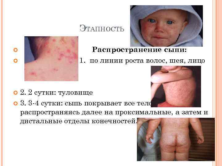 ЭТАПНОСТЬ Распространение сыпи: 1. по линии роста волос, шея, лицо 2. 2 сутки: туловище
