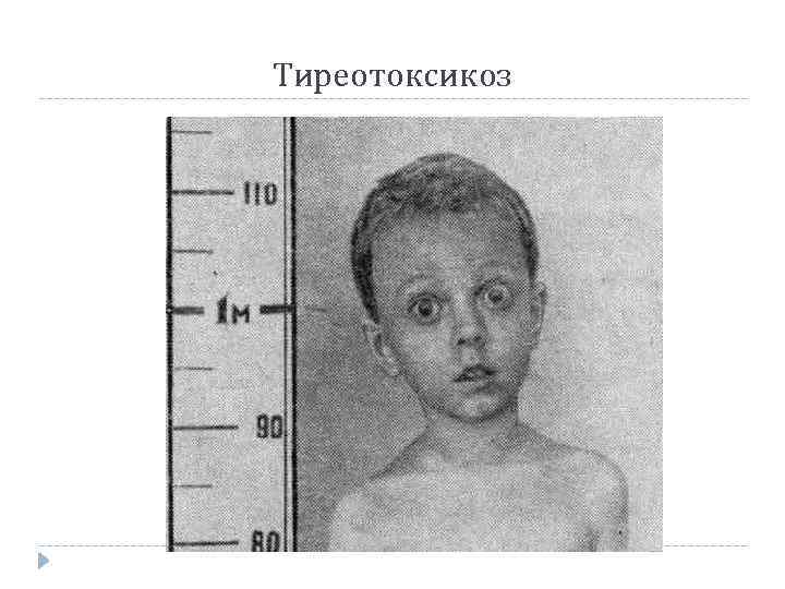 Гипотиреоз у девочек. Гипертиреоз щитовидной железы у детей. Щитовидная железа кретинизм.