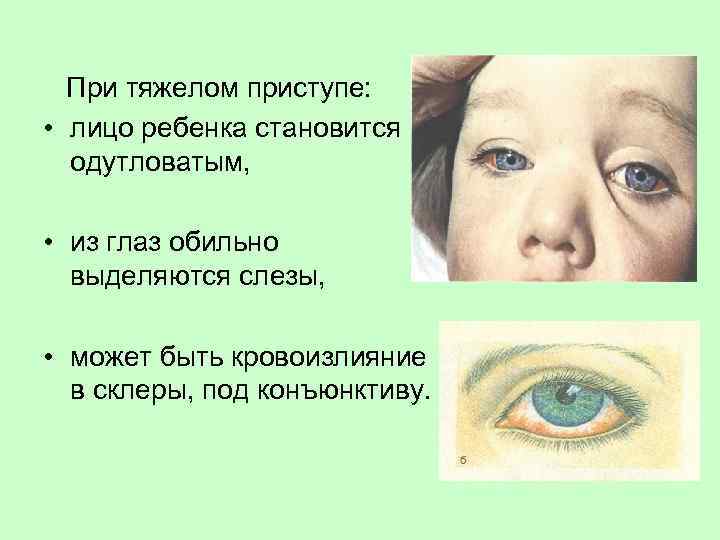 При тяжелом приступе: • лицо ребенка становится одутловатым, • из глаз обильно выделяются слезы,