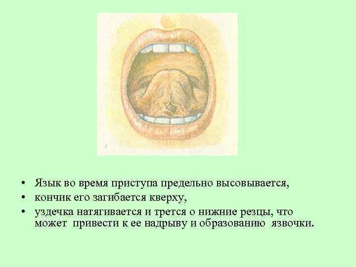  • Язык во время приступа предельно высовывается, • кончик его загибается кверху, •