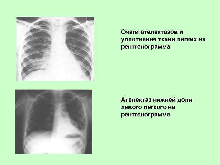 Очаги ателектазов и уплотнения ткани легких на рентгенограмма Ателектаз нижней доли левого легкого на