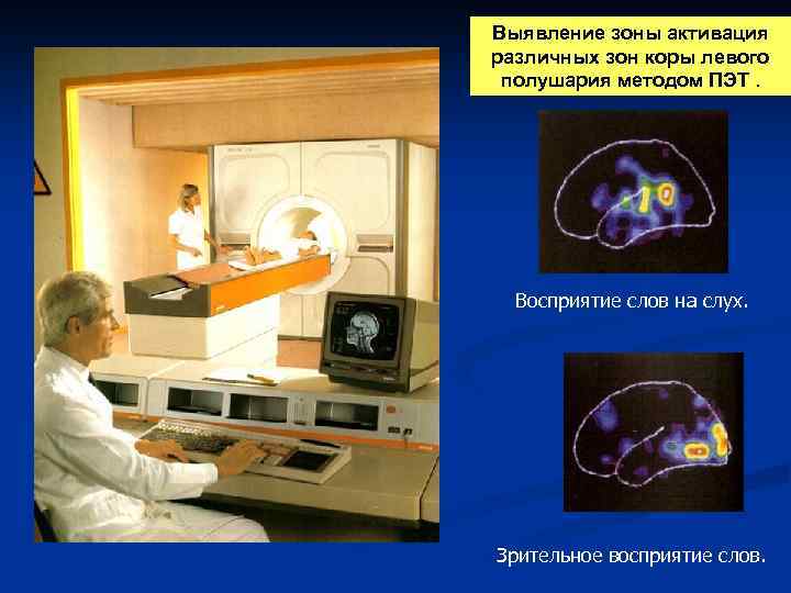 Выявление зоны активация различных зон коры левого полушария методом ПЭТ. Восприятие слов на слух.