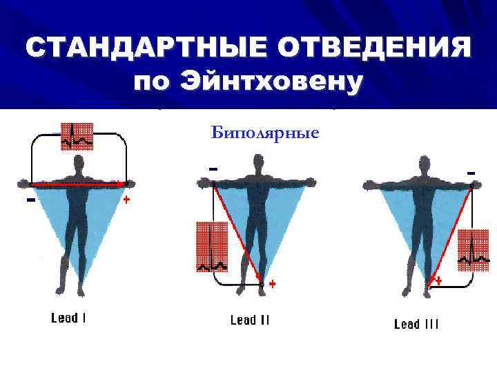 СТАНДАРТНЫЕ ОТВЕДЕНИЯ по Эйнтховену Биполярные 