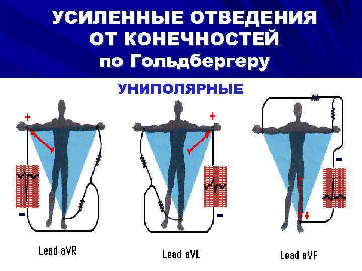 УСИЛЕННЫЕ ОТВЕДЕНИЯ ОТ КОНЕЧНОСТЕЙ по Гольдбергеру УНИПОЛЯРНЫЕ 
