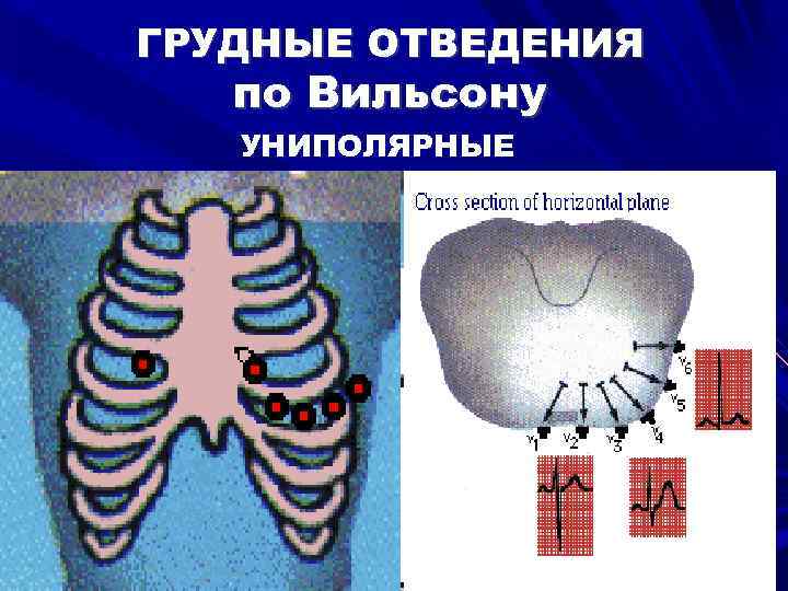 ГРУДНЫЕ ОТВЕДЕНИЯ по Вильсону УНИПОЛЯРНЫЕ 