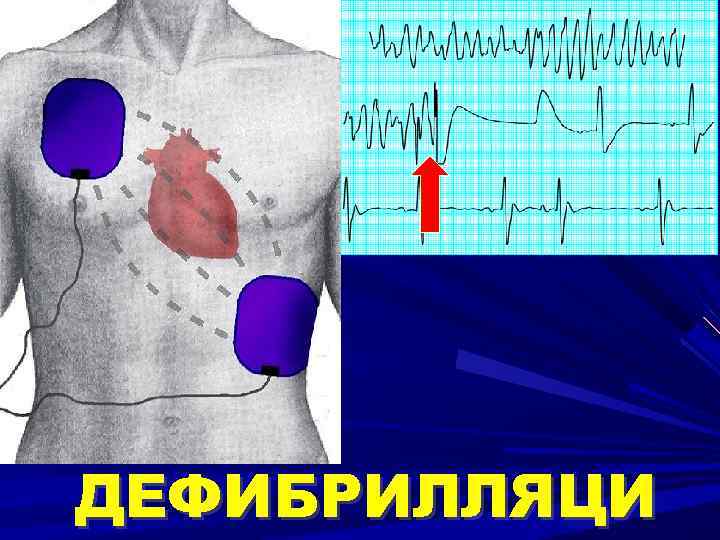 ДЕФИБРИЛЛЯЦИ 