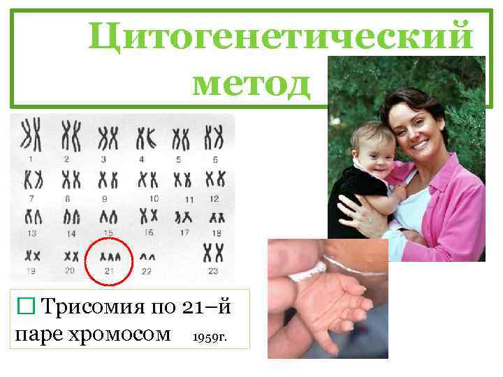 Цитогенетический метод Трисомия по 21–й паре хромосом 1959 г. 