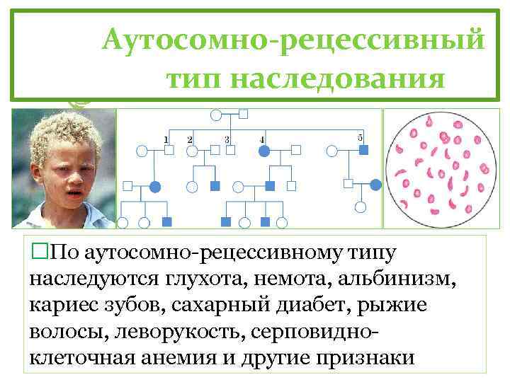 Аутосомно-рецессивный тип наследования По аутосомно-рецессивному типу наследуются глухота, немота, альбинизм, кариес зубов, сахарный диабет,