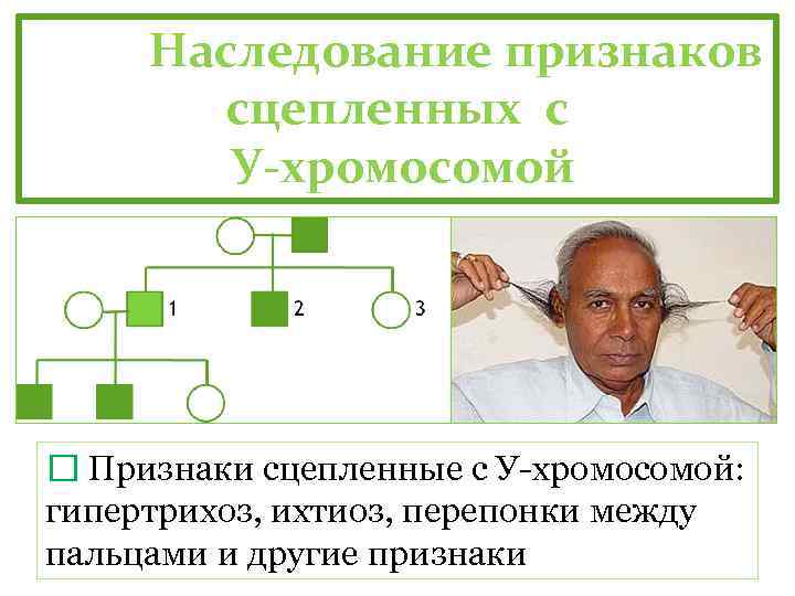 Наследование признаков сцепленных с У-хромосомой Признаки сцепленные с У-хромосомой: гипертрихоз, ихтиоз, перепонки между пальцами